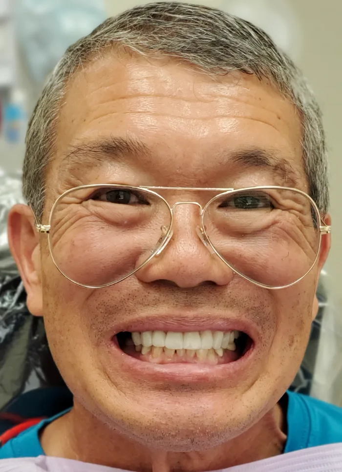Before and after dental result